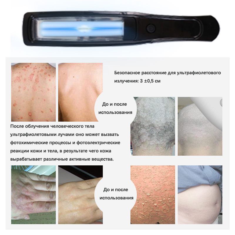 UVB Lamp for Therapy Psoriasis - Candle Making Supplies Uk บทวิจารณ์และราคา